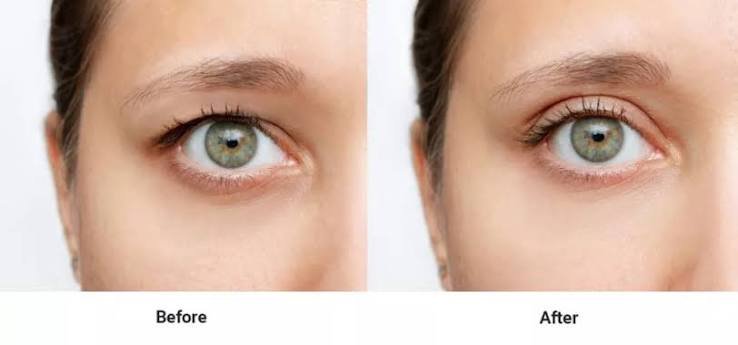 botox for eyelids