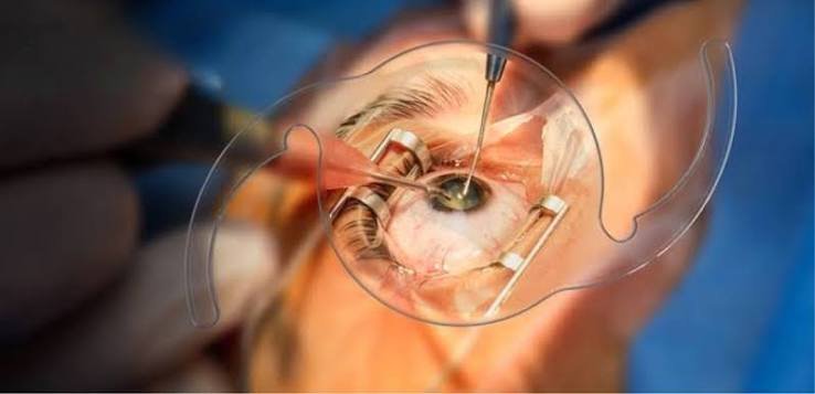 cataract treatment