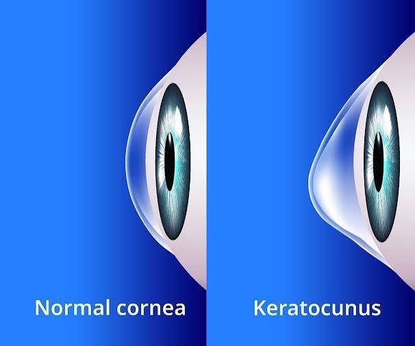 corneal transplant & keratoconus
