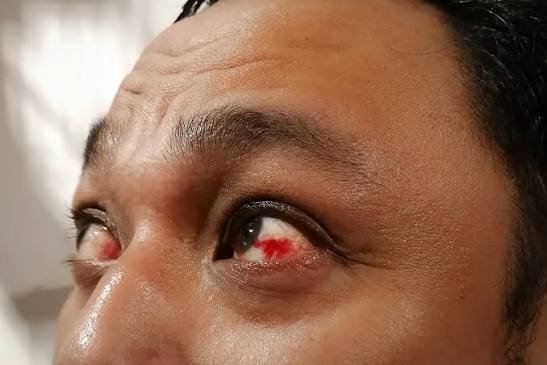 diabetic eye disease